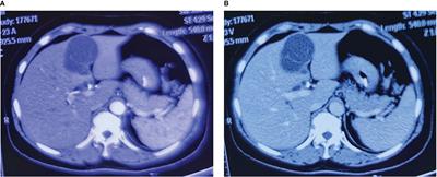 Case report: Obstructive jaundice caused by biliary cystadenoma